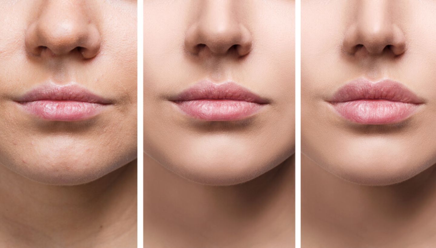 Russian Lip Filler Healing Process: Timeline and Tips