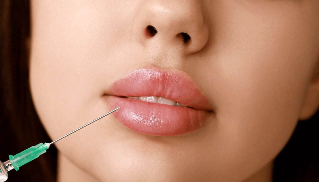 Exploring the Popularity of Russian Lip Filler Trend in the UK