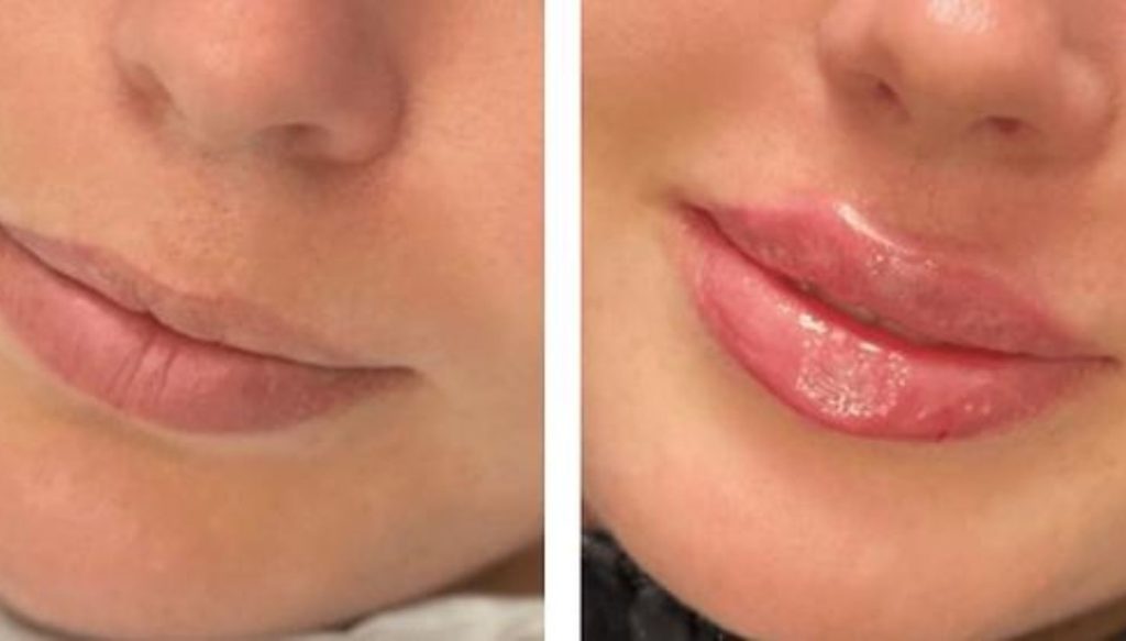 Russian Lips vs Normal Filler: Know the Differences