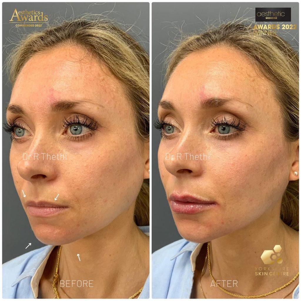 lip fillers before and after