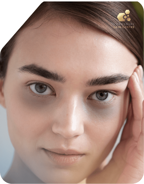 Dark Circles Under The Eyes