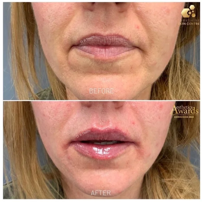 lip filler result by yorkshire skin centre