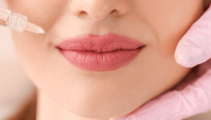 Butterfly Lip filler