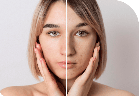 Age spots 37 Dermabrasion