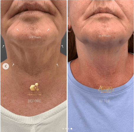 Double Chin 49 Julie Bower BA 3 2