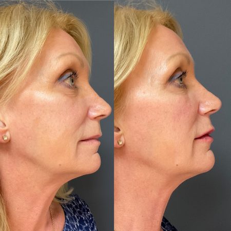 Double Chin 48 morpehus8 7 1