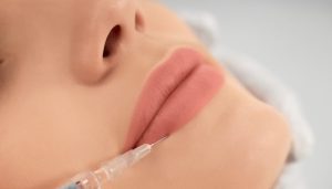 How Long Does it Take for Lip Filler to Settle