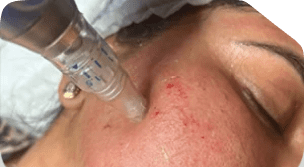 Ectropion Surgery 101 Rectangle 4478 1 17