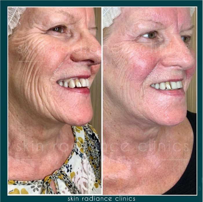 Chemical Peel 15 Chemical Peel Before and after