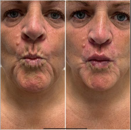 Teoxane 167 teoxane filler before and after