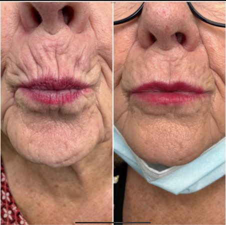 Teoxane 168 teoxane before and after