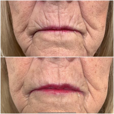 Teoxane 169 teoxane skin booster before and after