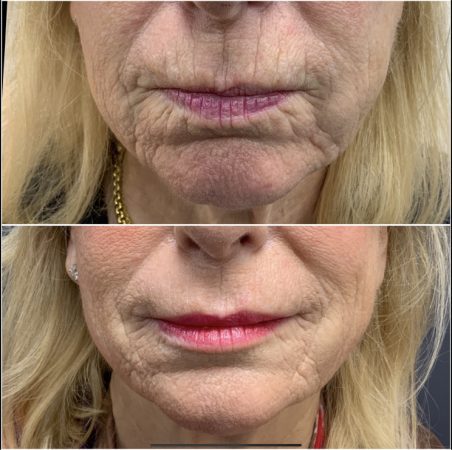 Teoxane 170 teoxane lip filler before and after images