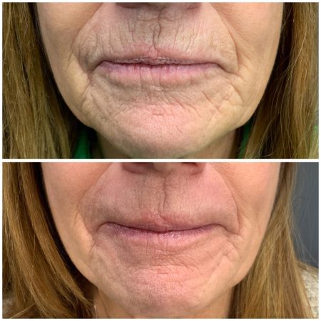 Teoxane 171 teoxane before and after images