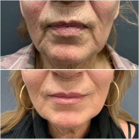 Teoxane 172 teoxane filler before and after images