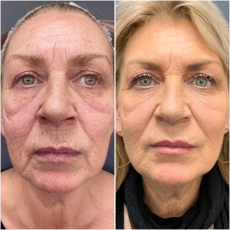 teoxane lip filler before and after