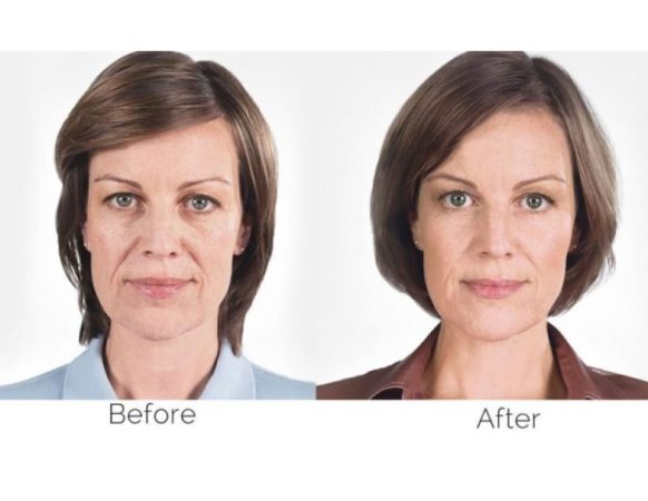 Sculptra 165 IMG 9417 1 2