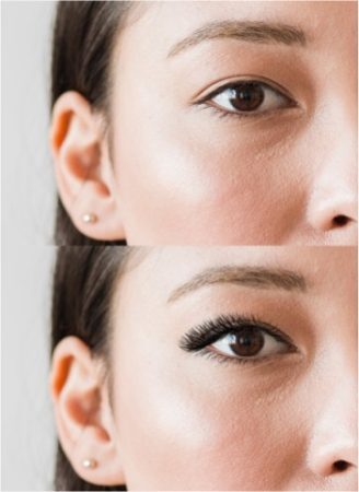 Ptosis 72 Women before and after Ptosis Correction
