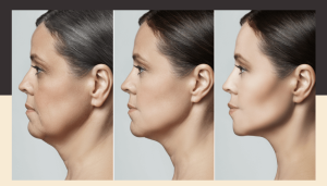 How to get rid of double chin