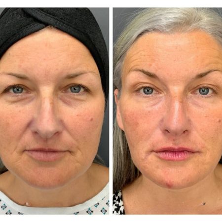 Signature Lift 65 11