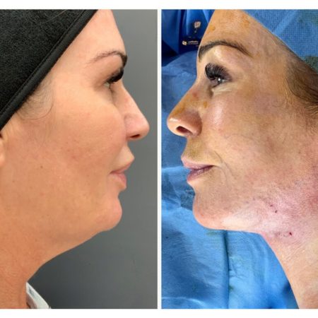 Signature Lift 66 12