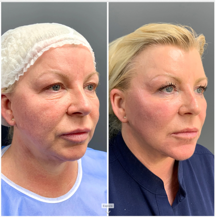 FaceTite 25 FacetiteBF1