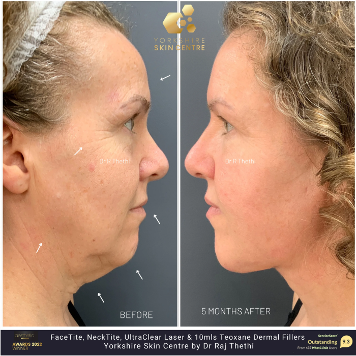 FaceTite 23 face 1 1