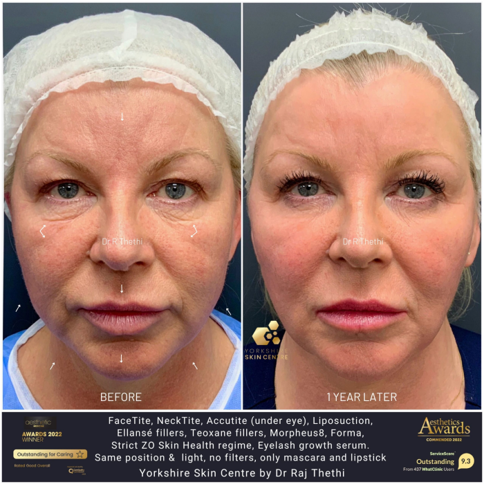 FaceTite 19 face 1 4