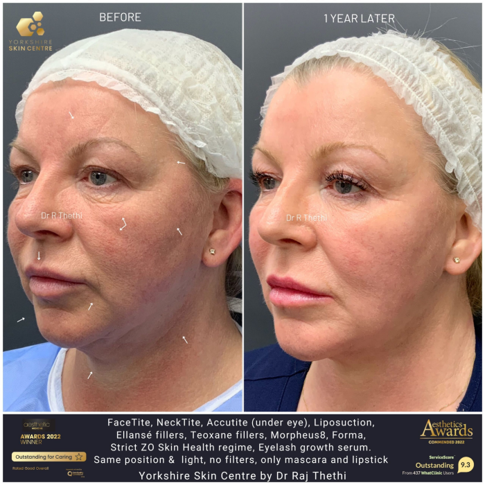 FaceTite 20 face 1 5