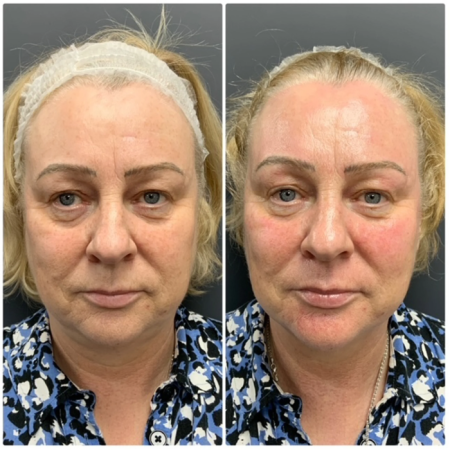 hydrafacialBeforeAfter1 1 1