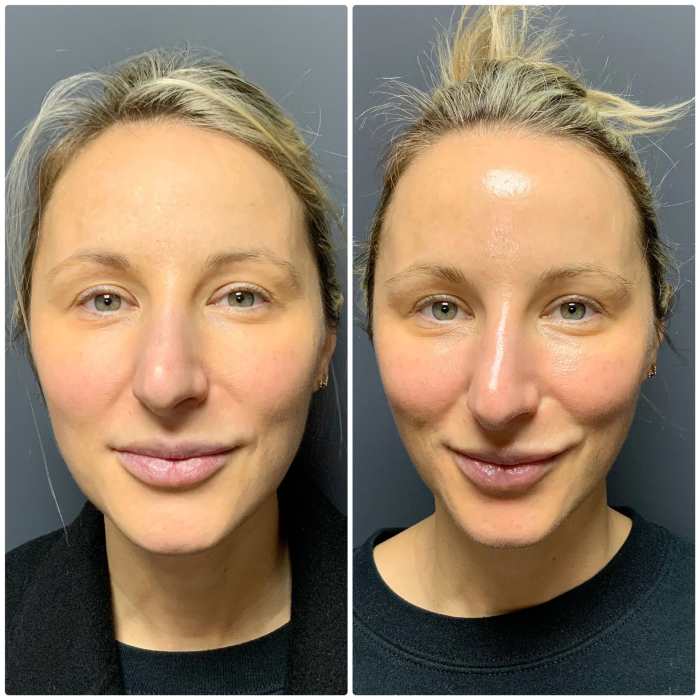 hydrafacialBeforeAfter1 1 2