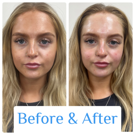 hydrafacialBeforeAfter1 1