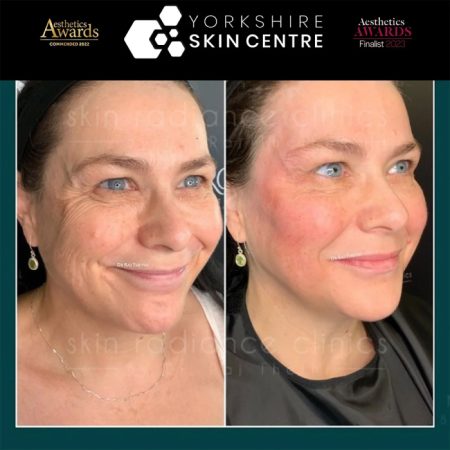 ThermaVein 74 BeforeAfter2ultraclear 1 1