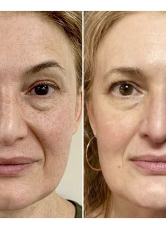 forma-non-invasive-skin-tightening 86 Forma Non- Invasive Skin Tightening Treatment transformation