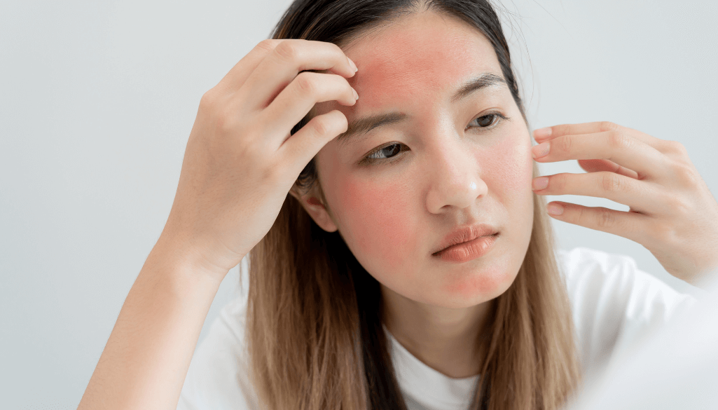 How To Get Rid Of Rosacea Permanently? Is It Possible?