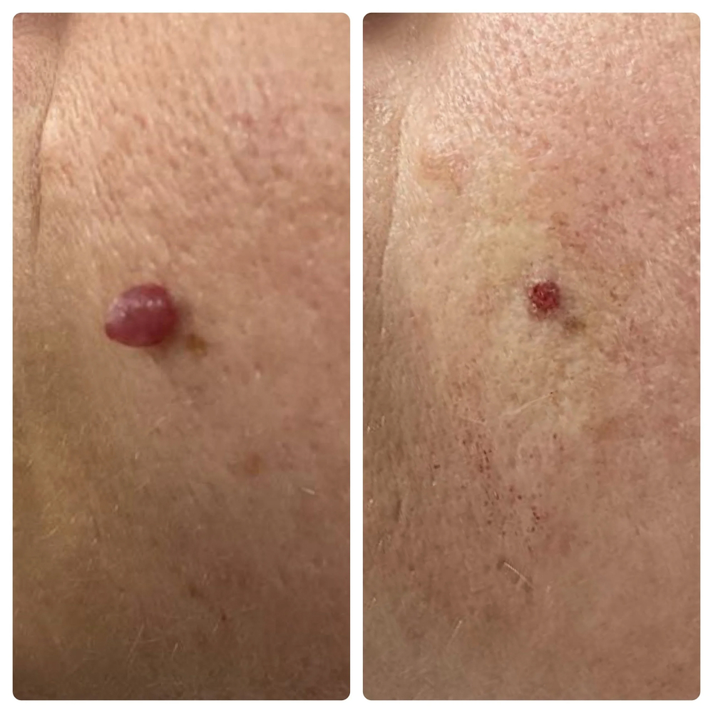 Mole Removal Before and After