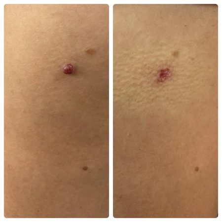 Mole Removal Before and After result