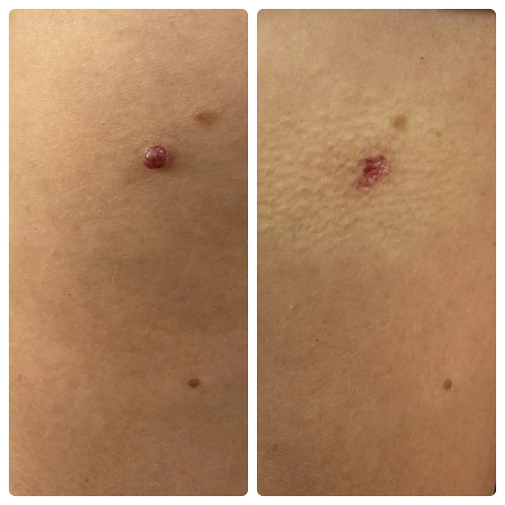 Mole Removal 16 Mole Removal Before and After result