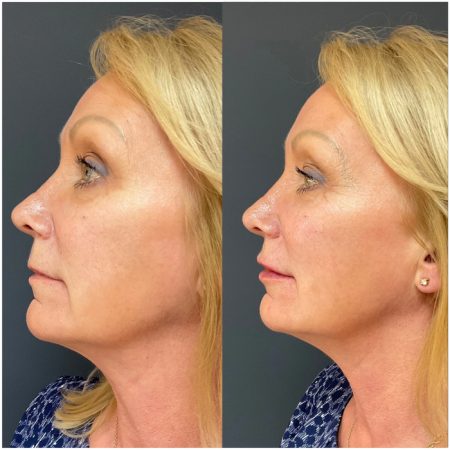 Morpheus8 57 Morpheus8bf1 1 2