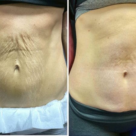 Morpheus8 58 Morpheus8bf1 1 4