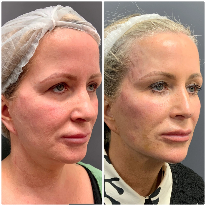 NEckTighteningbf1 1 1 1