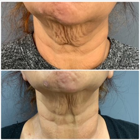 NEckTighteningbf1 1 1 3