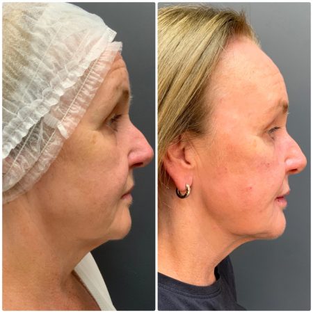 NEckTighteningbf1 1 1 4