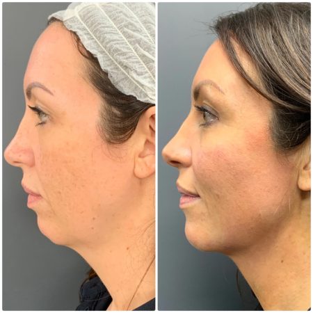 NEckTighteningbf1 1 1