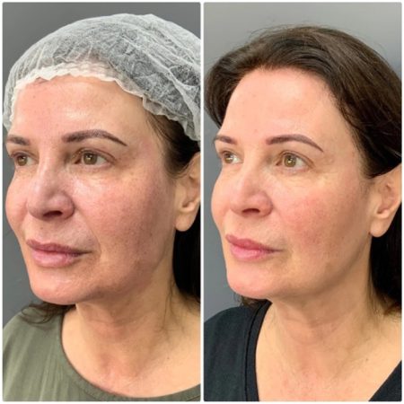 Neogen Plasma 100 Neogen4 1 4