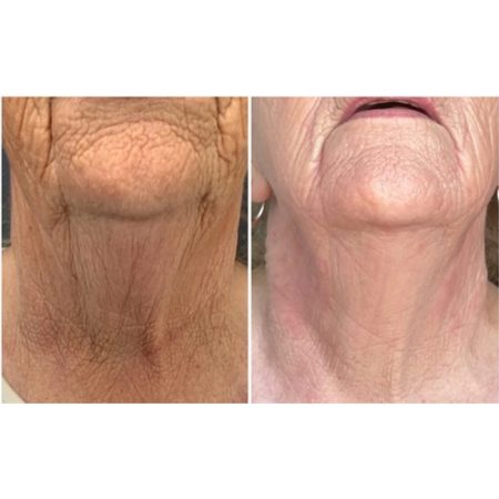 Neogen Plasma 102 Neogen4 1 6