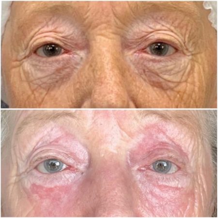 Neogen Plasma 104 Neogen4 1 8