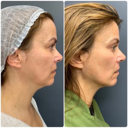 Neogen Plasma 105 Neogen4 1 9