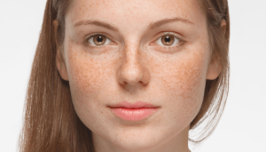 Rosacea: What It Is, Causes and Symptoms