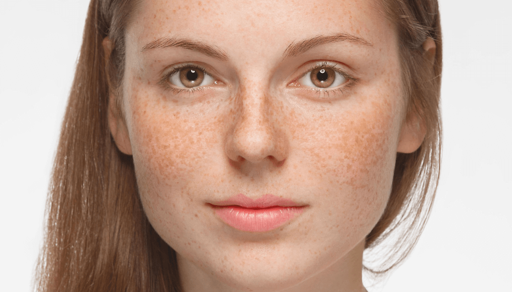 What is Rosacea? Explore its Cause, Types and Symptoms